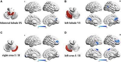 Altered Cerebellar-Cerebral Circuits in Patients With Type 2 Diabetes Mellitus